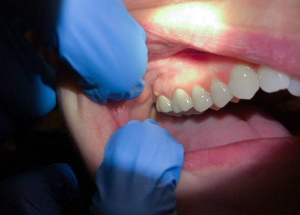 Best Emergency Dental Care for Broken or Chipped Teeth in Summitville, IN